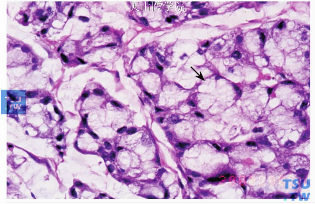 黏液腺癌：部分肿瘤细胞排列呈腺泡样