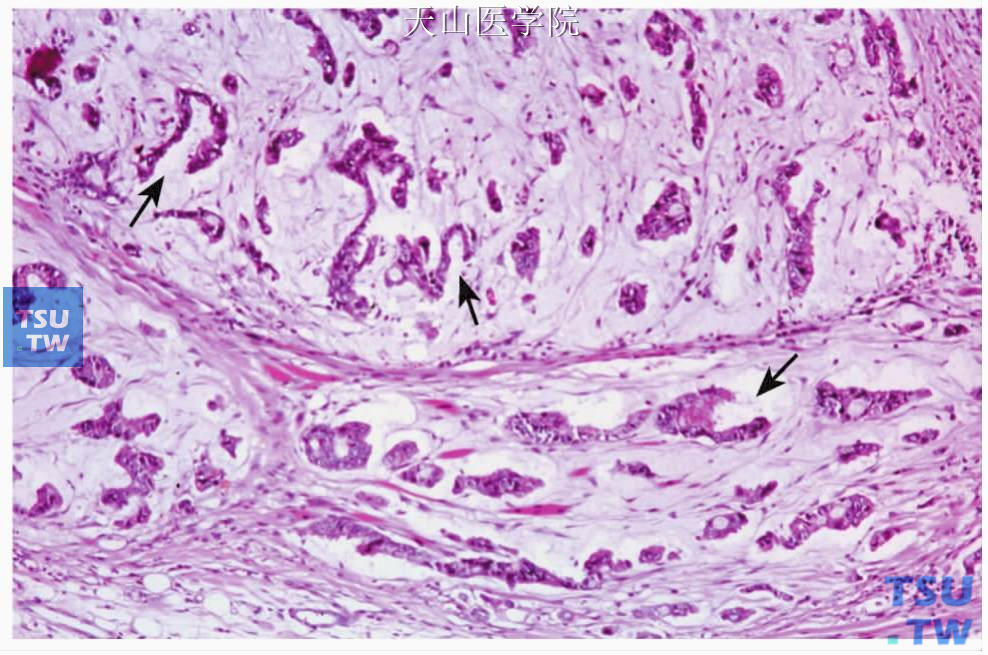 黏液腺癌：肿瘤形成不规则腺样结构，之间为大量黏液，浸润肌组织