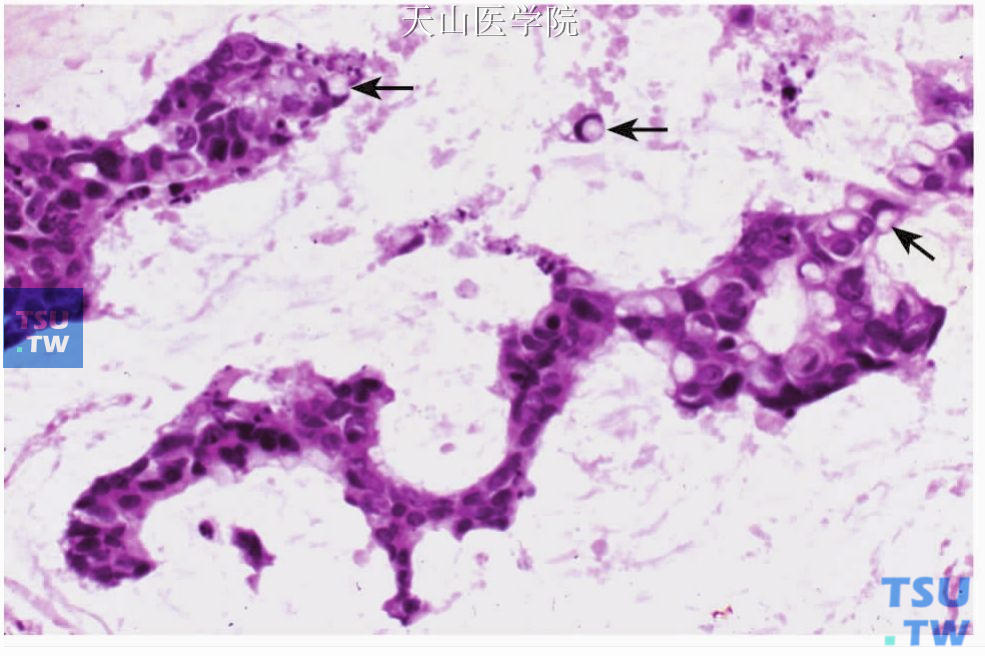 黏液腺癌：部分肿瘤细胞呈印戒样