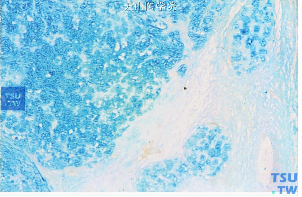 黏液腺癌：肿瘤细胞奥新兰染色阳性