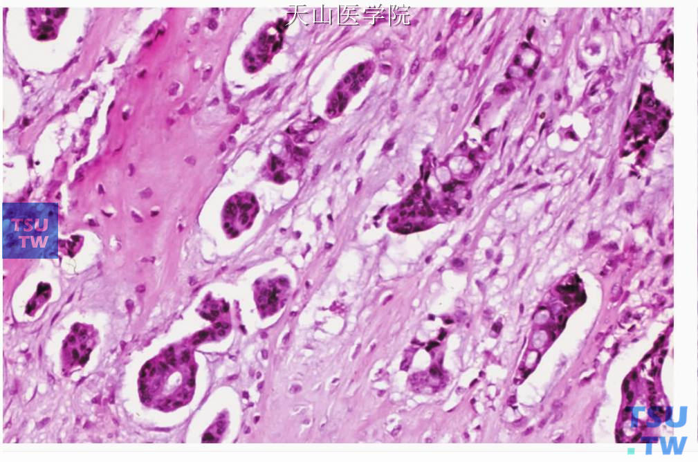 黏液腺癌：肿瘤侵犯骨组织
