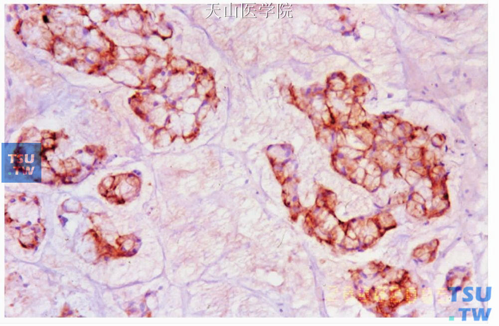 黏液腺癌：肿瘤细胞表达细胞角蛋白