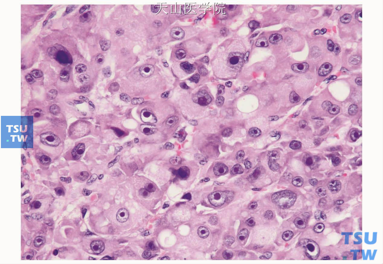 嗜酸细胞癌：肿瘤细胞胞质嗜酸性细颗粒状，有异型性的泡状胞核、核仁明显