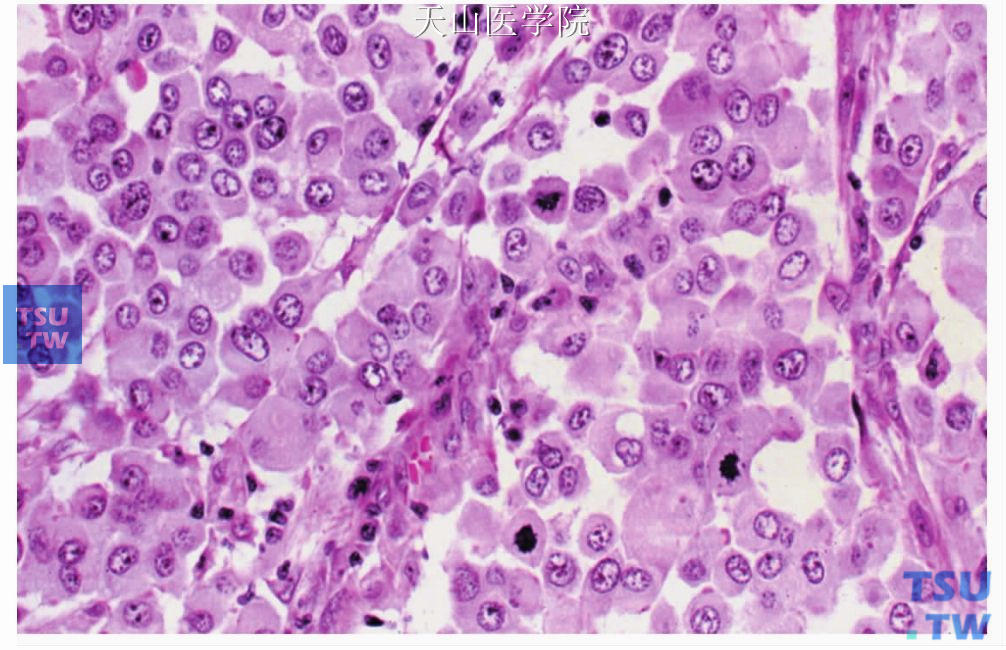 嗜酸细胞癌：肿瘤中核分裂较多