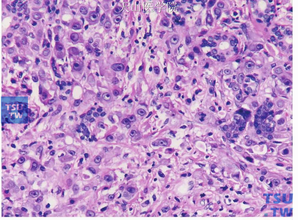 嗜酸细胞癌：肿瘤细胞分散浸润，个别呈单个细胞浸润
