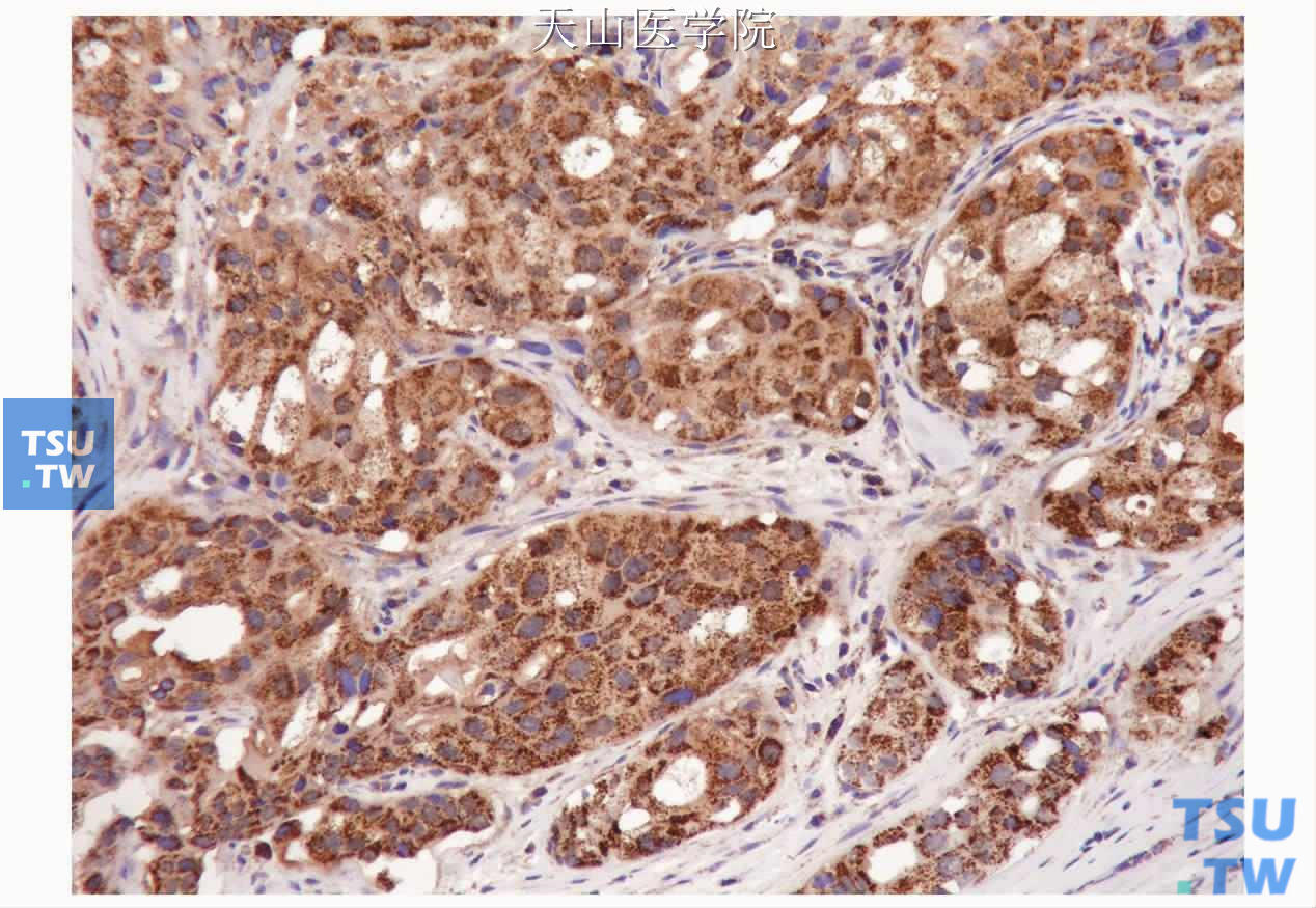 嗜酸细胞癌：肿瘤细胞强表达线粒体抗原，免疫组化染色