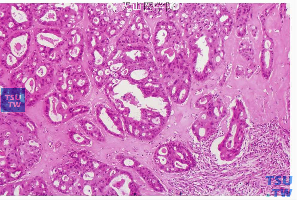 唾液腺导管癌：大小不等的囊性或实体性肿瘤结节位于致密的胶原性间质中