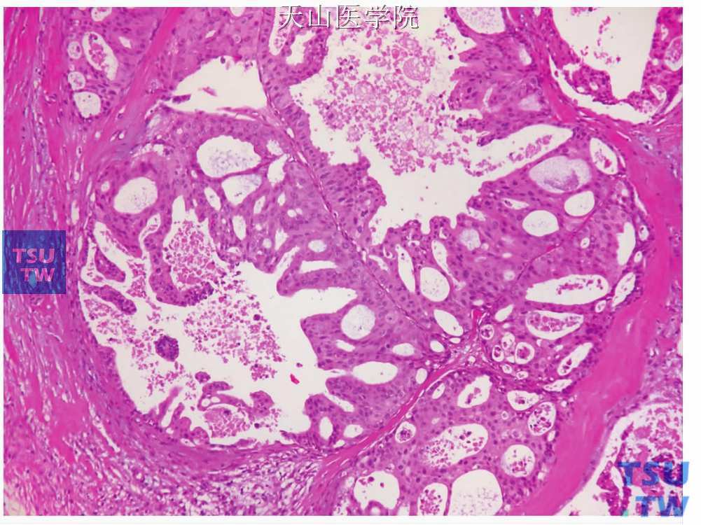 唾液腺导管癌：结节内的肿瘤细胞形成乳头状结构