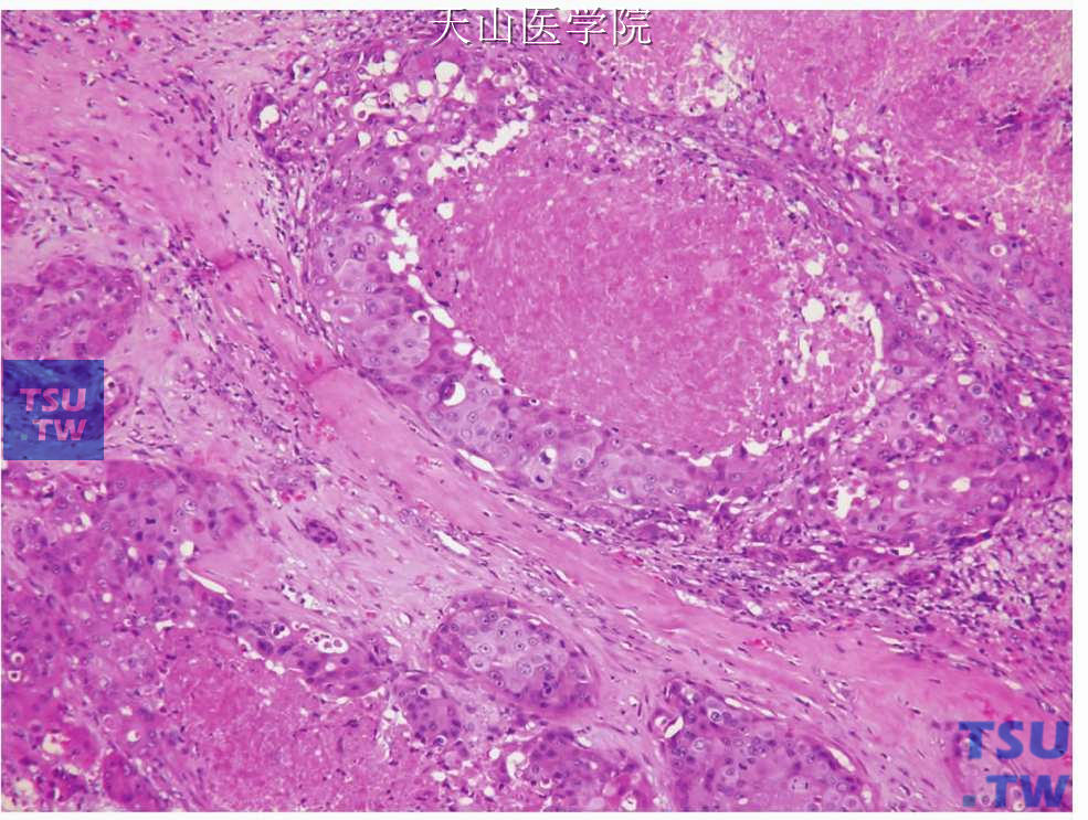 唾液腺导管癌：肿瘤细胞团中央的粉刺样坏死
