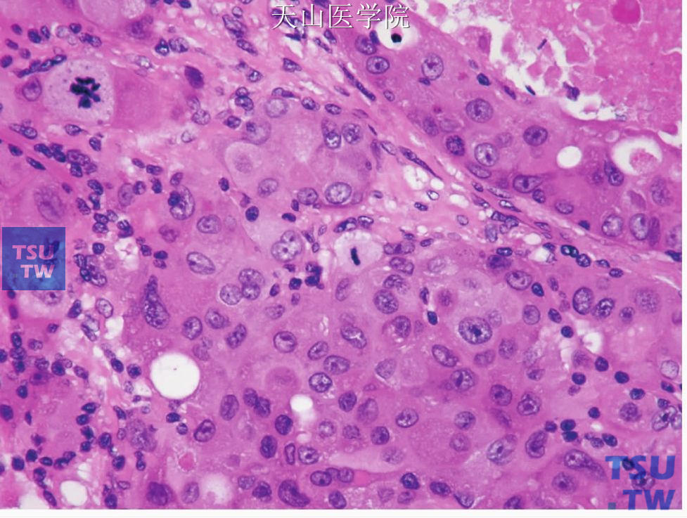 唾液腺导管癌：肿瘤细胞的多形性和核分裂常见