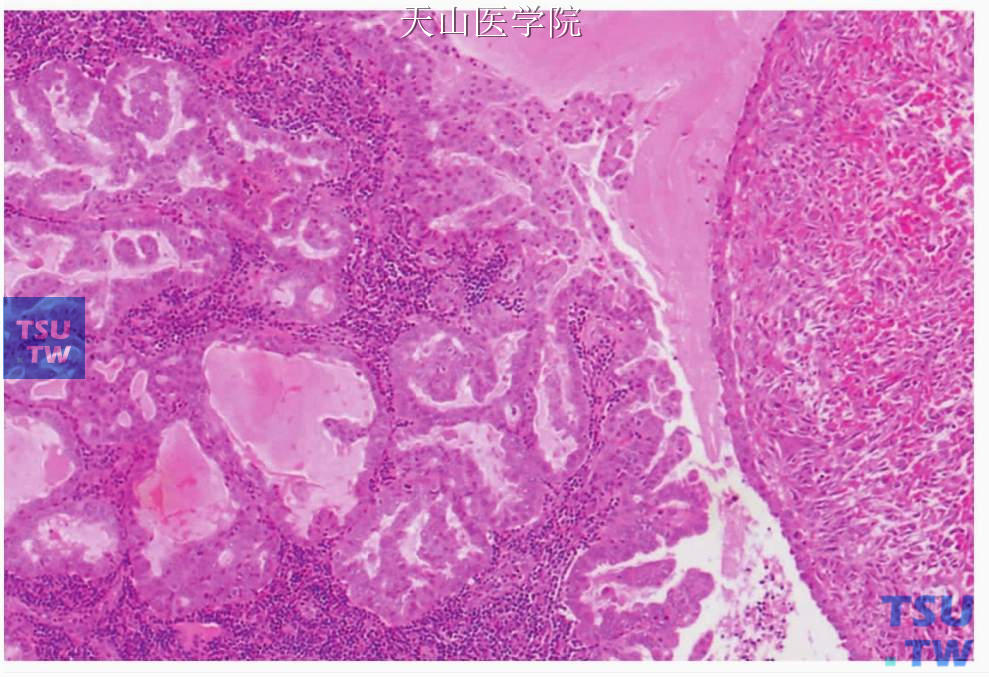 肉瘤样型唾液腺导管癌：导管癌成分（左侧）和肉瘤样成分（右侧）