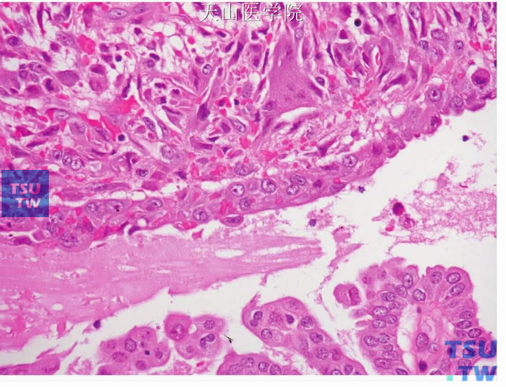 肉瘤样型唾液腺导管癌：肉瘤样成分中可见多核巨细胞