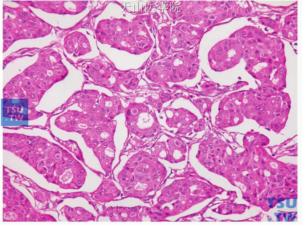侵袭性微乳头型唾液腺导管癌：肿瘤细胞排列成小团