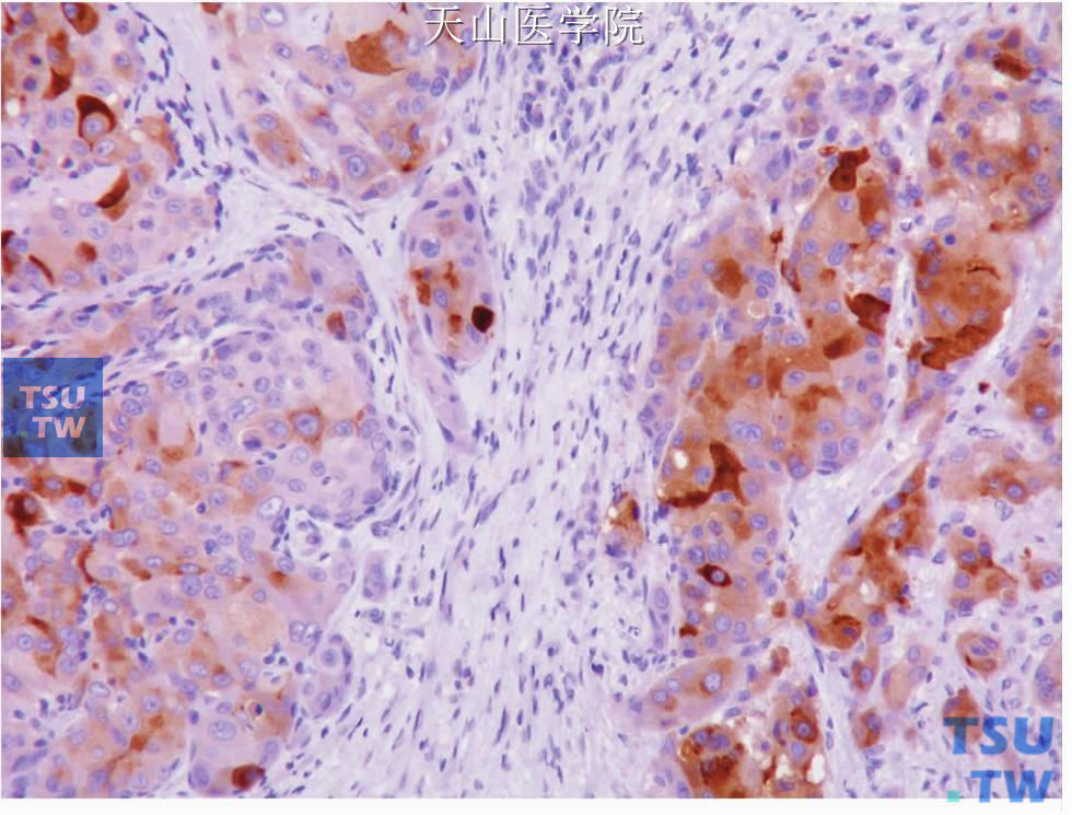 唾液腺导管癌：肿瘤细胞表达大囊病液体蛋白15，免疫组化染色