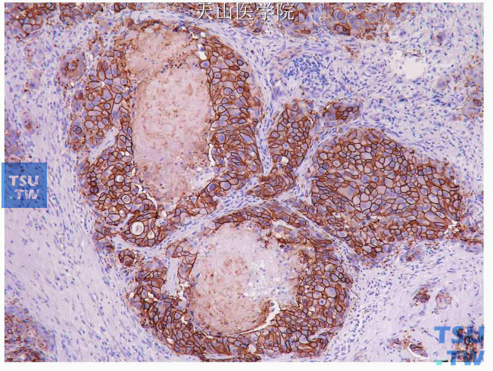 唾液腺导管癌：肿瘤细胞膜表达HER2蛋白，免疫组化染色