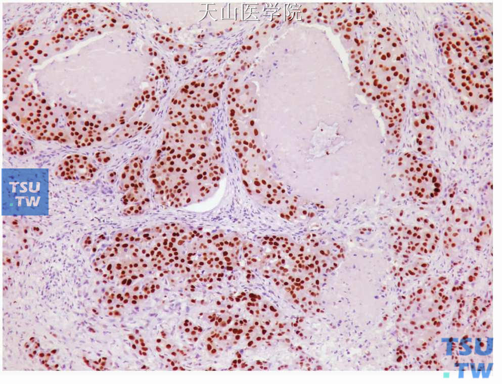 唾液腺导管癌：肿瘤细胞表达雄性激素受体，免疫组化染色