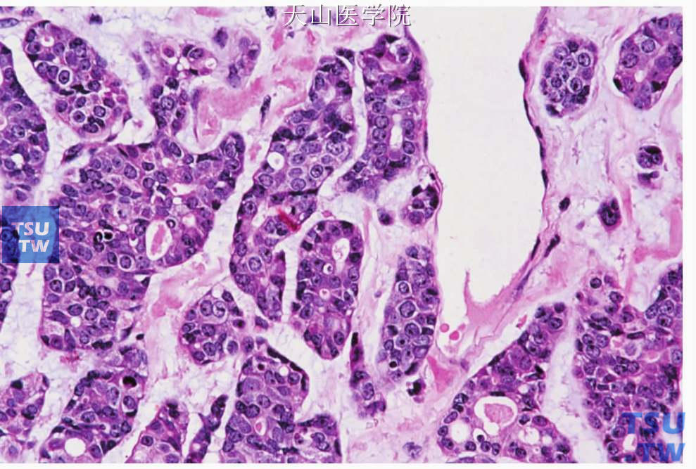 非特异性腺癌：肿瘤细胞呈立方状