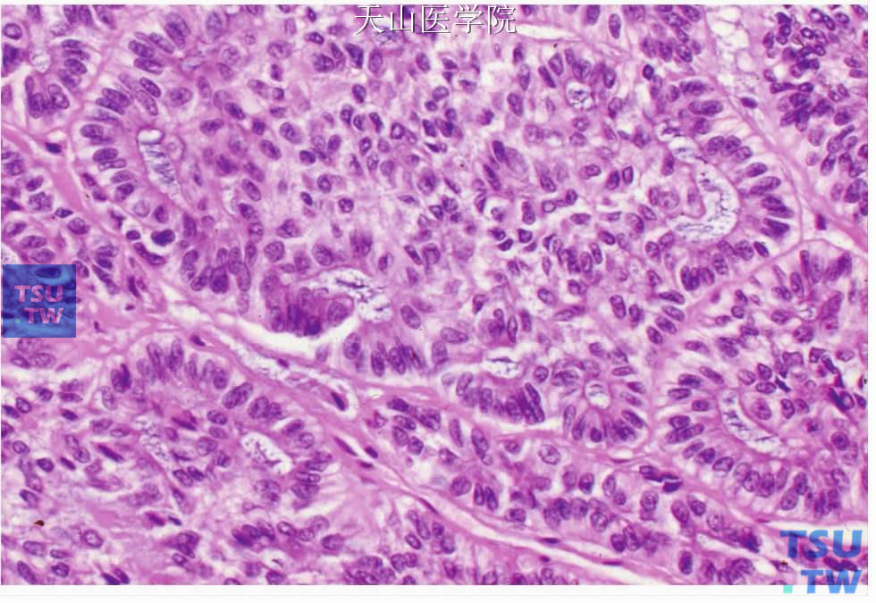 非特异性腺癌：肿瘤细胞呈柱状
