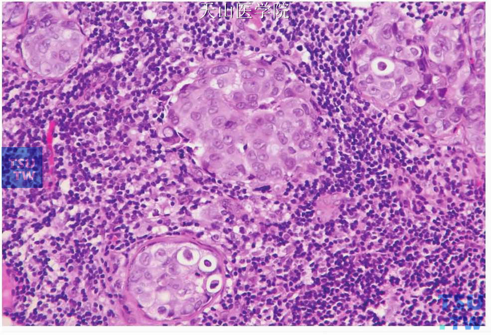 非特异性腺癌：肿瘤细胞为多边形