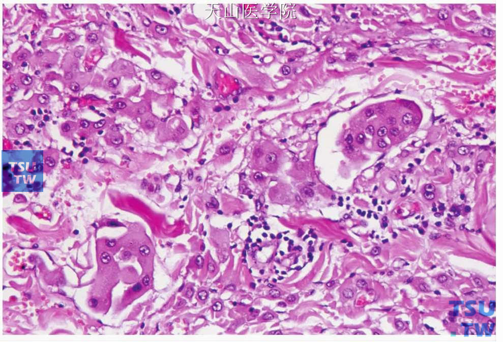 非特异性腺癌：肿瘤细胞胞质嗜酸性