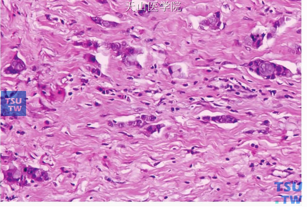 非特异性腺癌：肿瘤细胞胞质呈黏液样。间质胶原纤维密集
