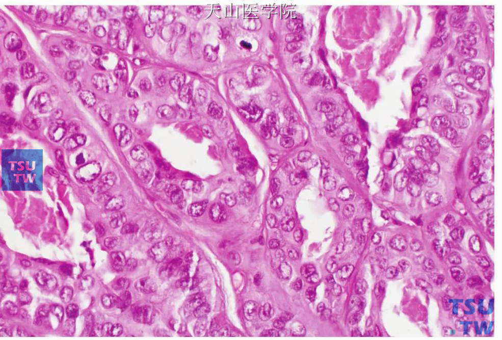 非特异性腺癌：肿瘤细胞排列成腺样
