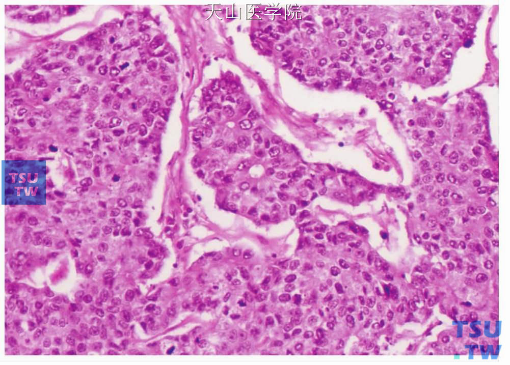 非特异性腺癌：肿瘤细胞排列成片。可见较多的核分裂