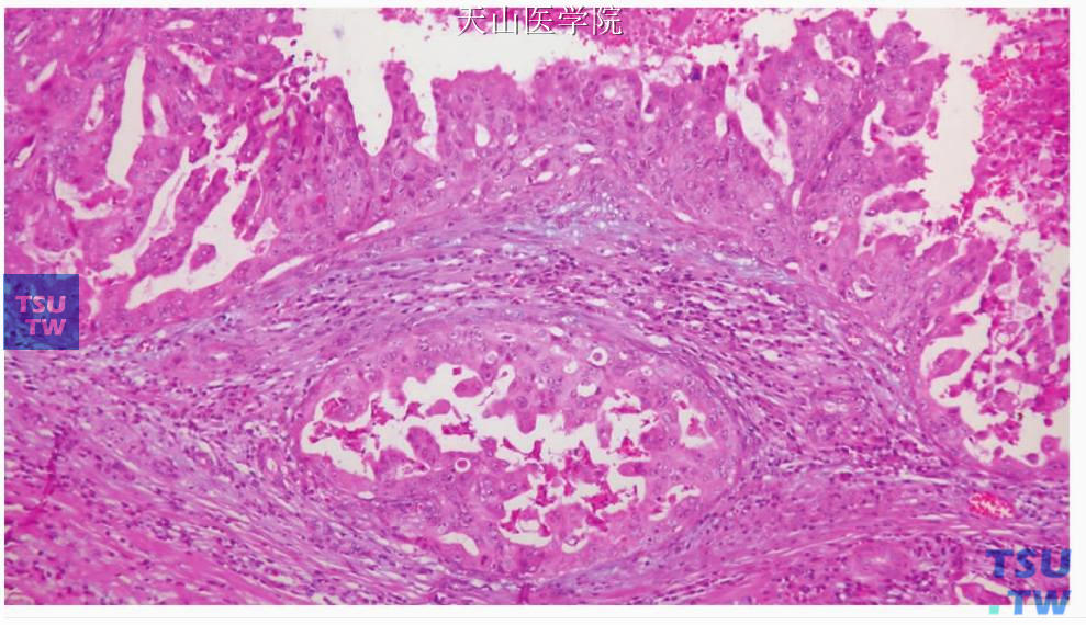 非特异性腺癌：肿瘤细胞形成乳头并见坏死
