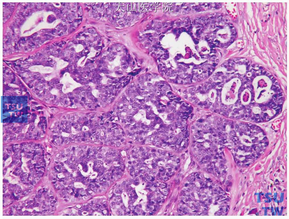 非特异性腺癌：单一的肿瘤细胞形成筛状结构