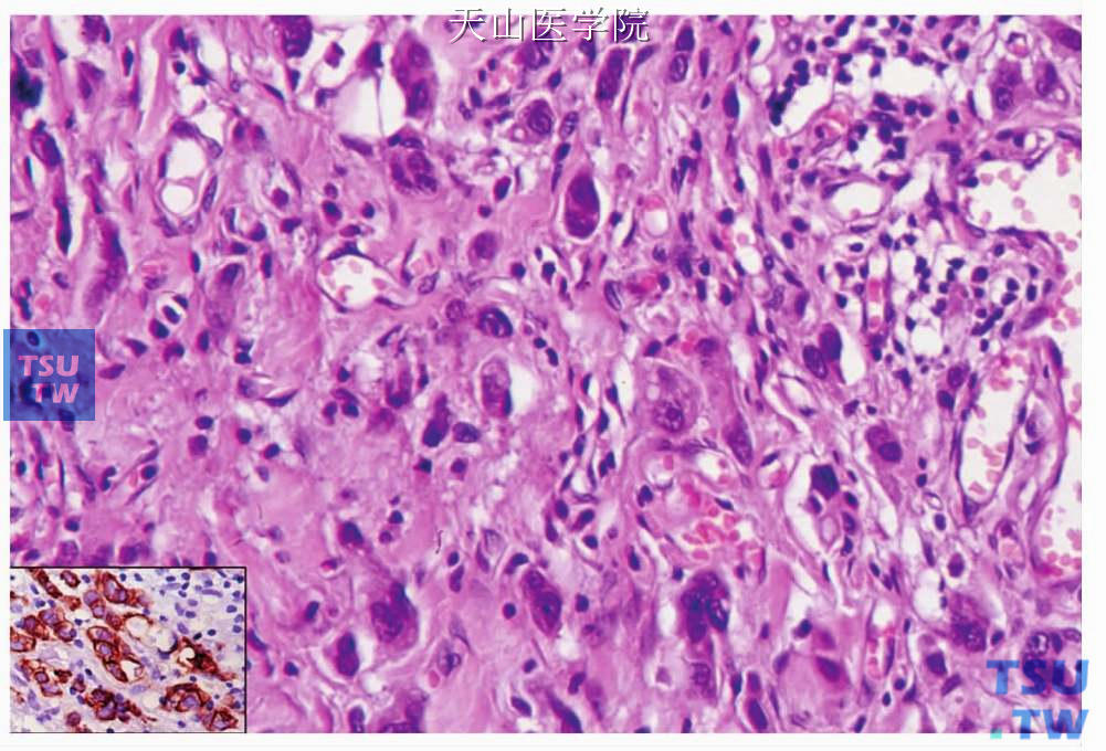 非特异性腺癌：小条索和小团细胞浸润性生长，插图为CK免疫组化染色