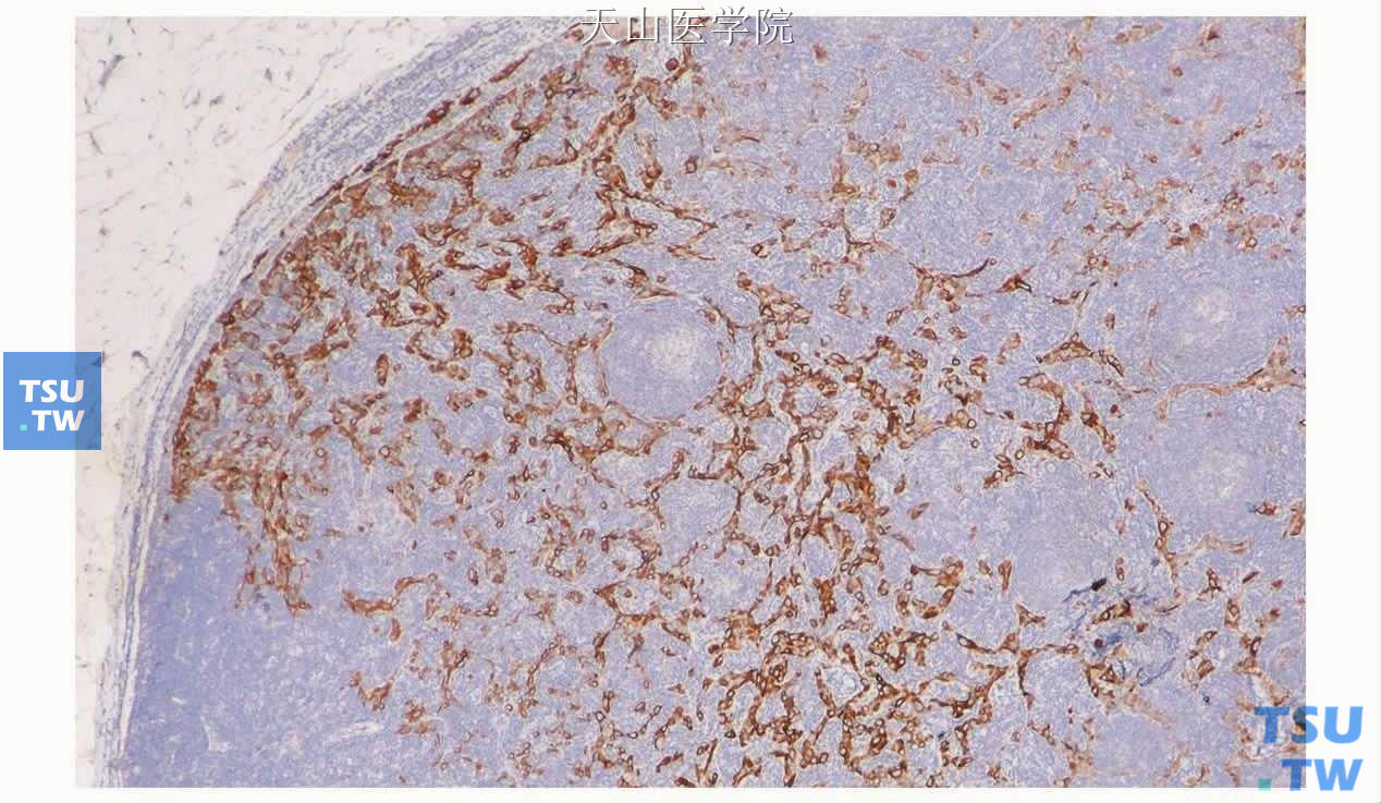 非特异性腺癌：淋巴结转移的癌细胞散在分布。CK（AE1/3）免疫组化染色