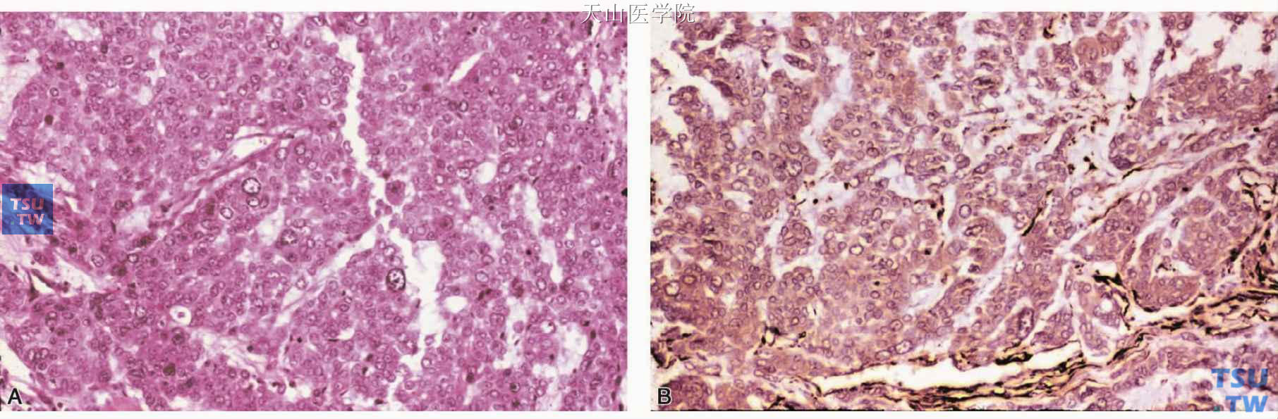 上皮样细胞肌上皮癌 A.肿瘤细胞类似于腺上皮细胞；B.肿瘤细胞表达SMA，免疫组化染色