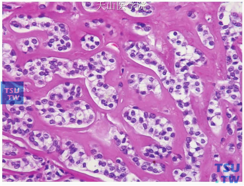 透明细胞肌上皮癌：肿瘤细胞间有较多细胞外基质