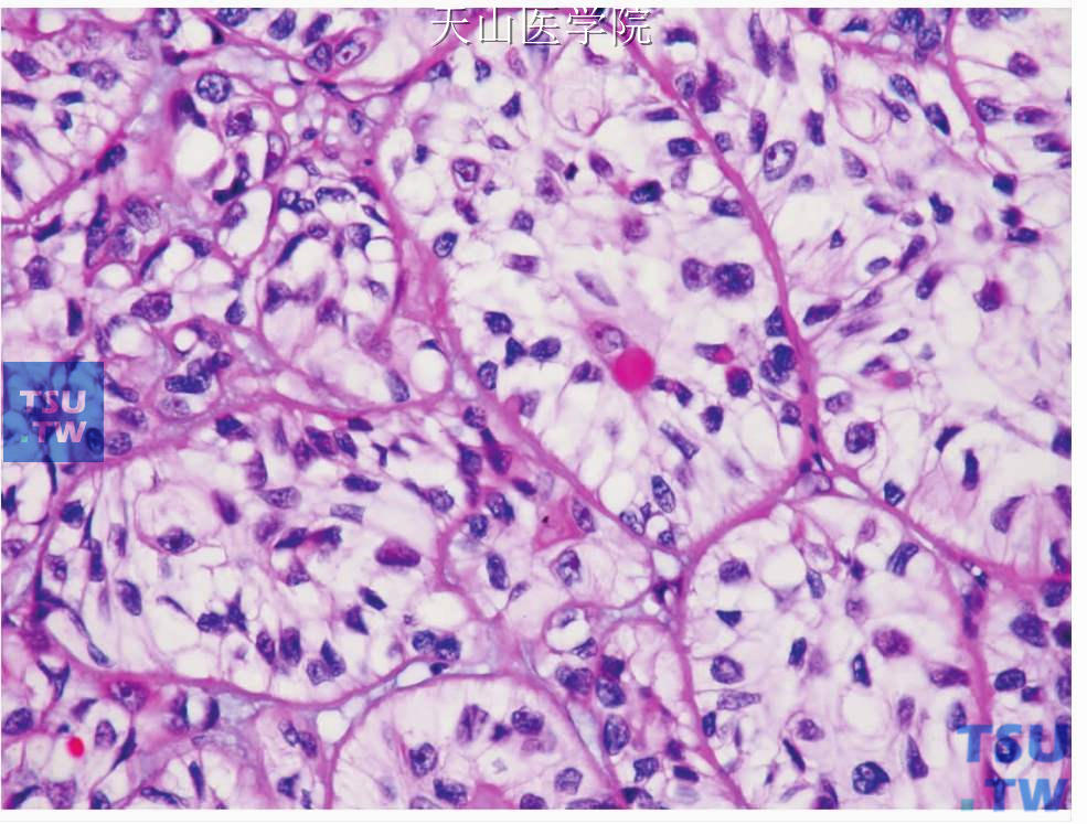 透明细胞肌上皮癌：肿瘤细胞的细胞外基质较少