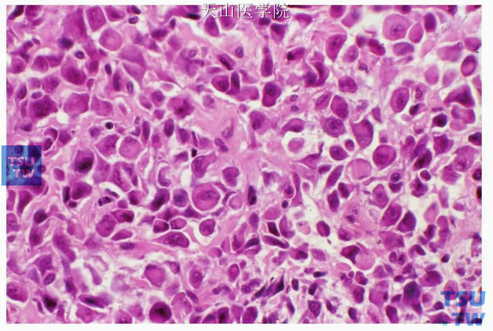 浆细胞样肌上皮癌：肿瘤细胞含较多胞质，细胞核偏位，具有异型性