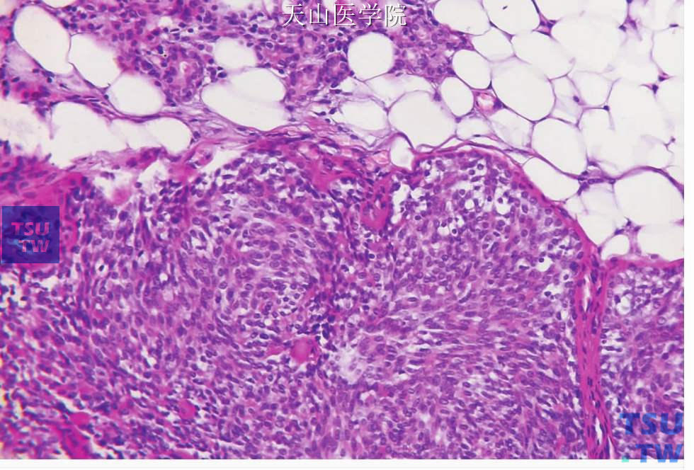 梭形细胞肌上皮癌：肿瘤浸润脂肪组织