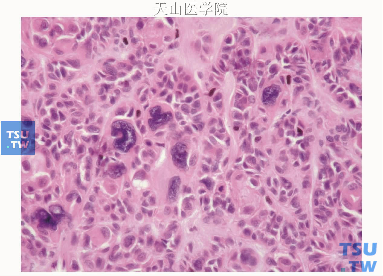 肌上皮癌：见形态怪异的大细胞