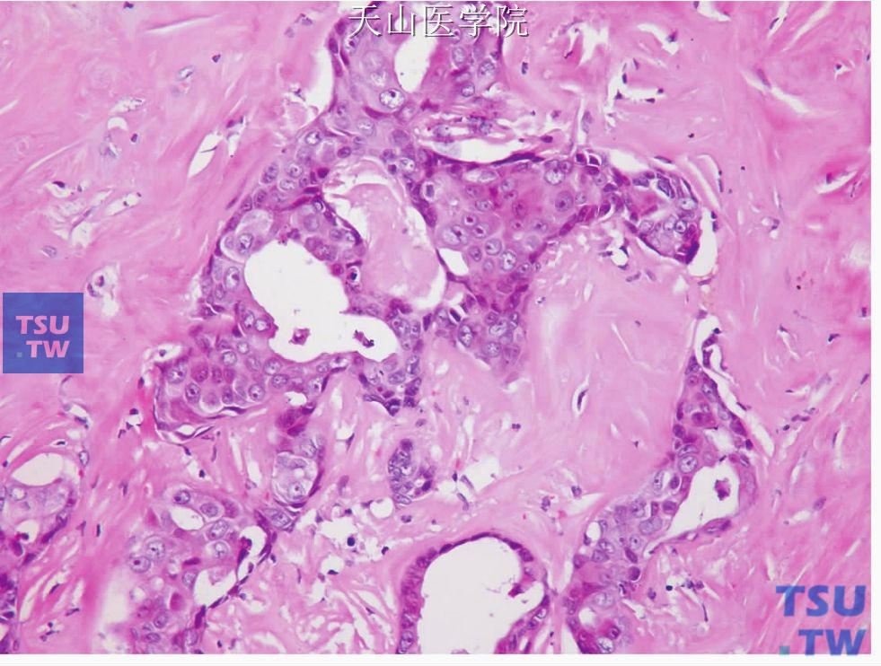 多形性腺瘤癌变：位于多形性腺瘤玻璃样变区的癌变，癌变成分为非特异性腺癌