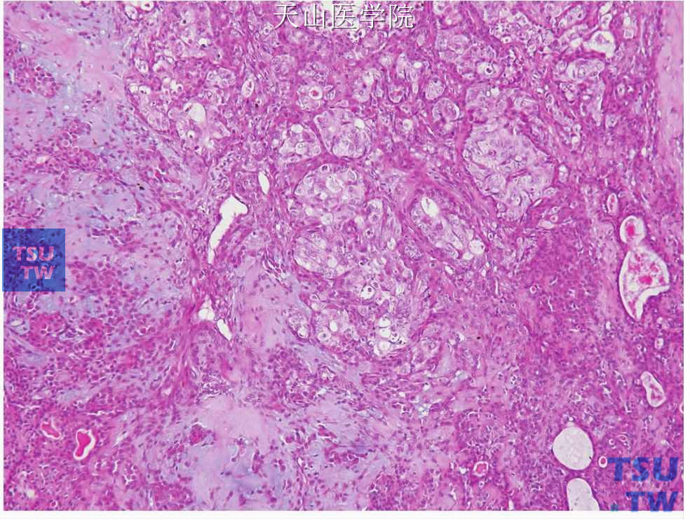 多形性腺瘤癌变：癌变成分为非特异性腺癌，癌变位于图的右上方