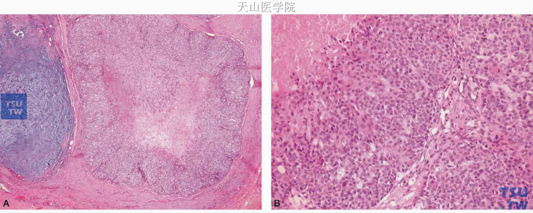 多形性腺瘤癌变 A.癌变成分为肌上皮癌，位于图右侧；B.高倍镜下见肿瘤组织坏死及肿瘤细胞核分裂