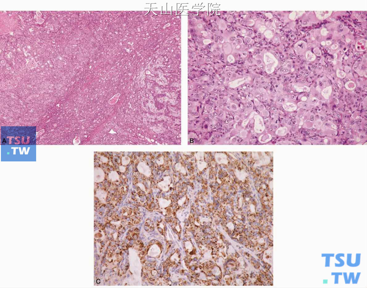 多形性腺瘤癌变 A.癌变成分为嗜酸细胞腺癌，位于图左侧；B.高倍镜见含丰富嗜酸性细颗粒胞质；C.肿瘤细胞线粒体免疫组化染色阳性