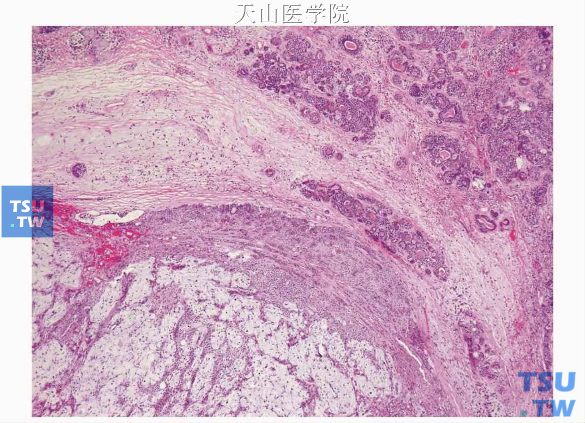 多形性腺瘤癌变 癌变成分为上皮肌上皮癌（图右上方）