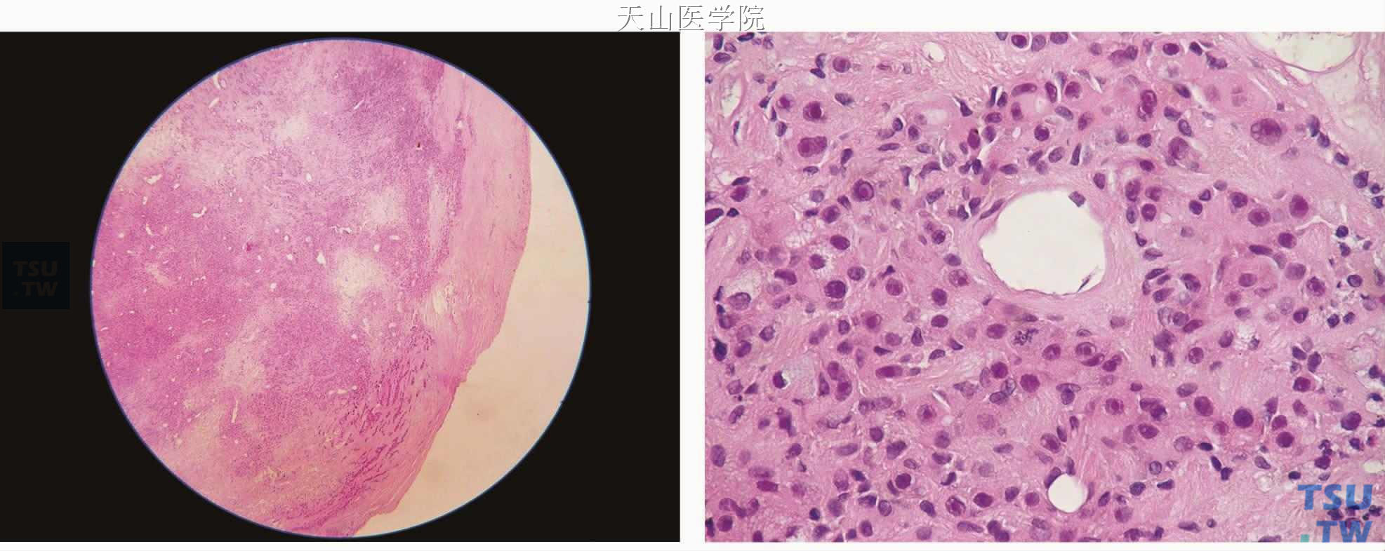 多形性腺瘤癌变：非侵袭性癌，癌变成分为肌上皮癌