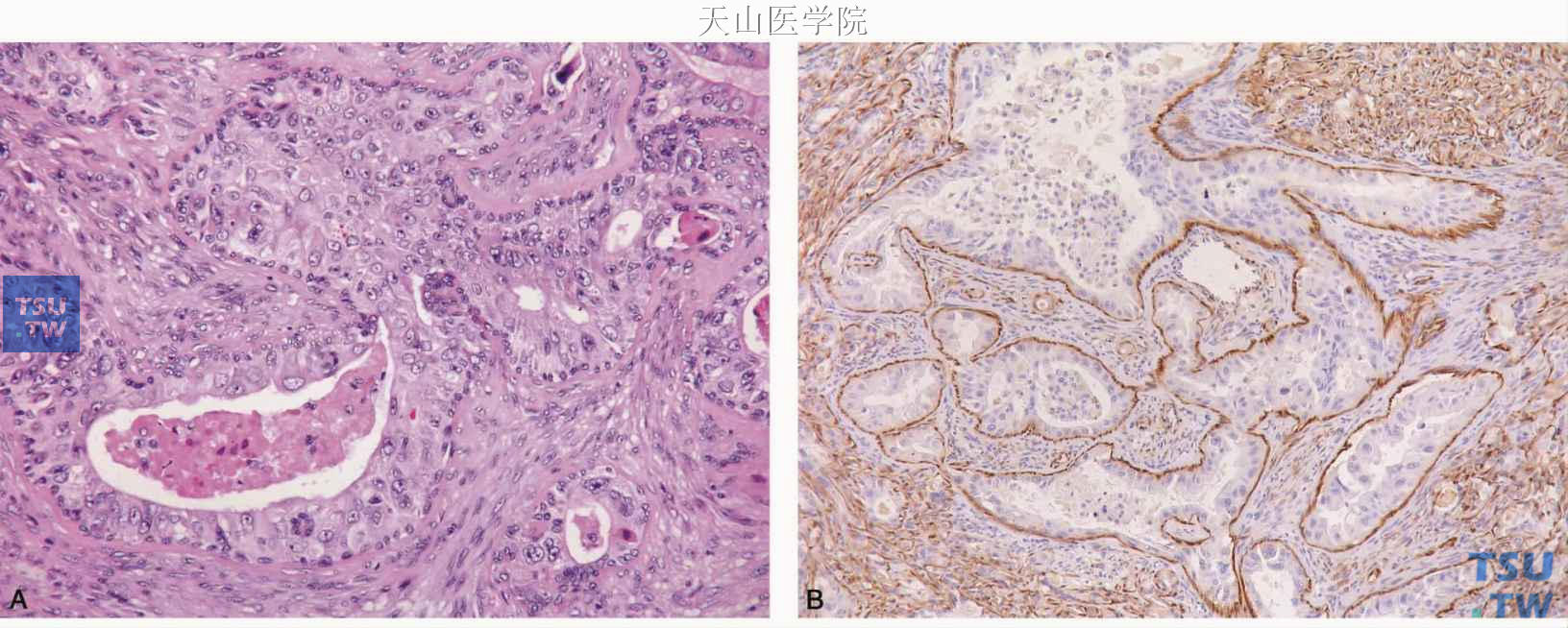 多形性腺瘤原位癌变 A.肿瘤细胞外围有肌上皮细胞包绕；B.免疫组织化学调宁蛋白染色显示肌上皮细胞包绕癌变肿瘤细胞