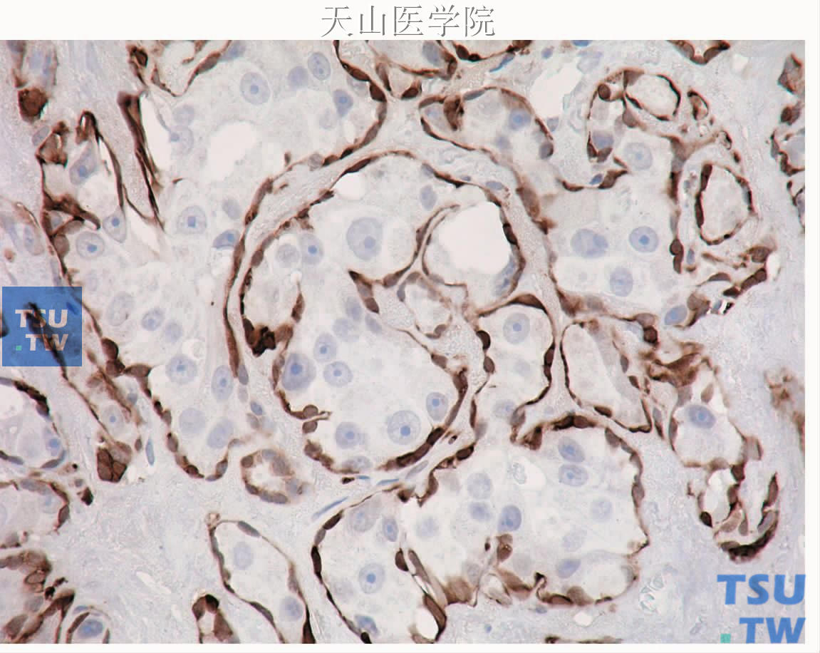 多形性腺瘤癌变：肿瘤细胞完全被肌上皮细胞包绕