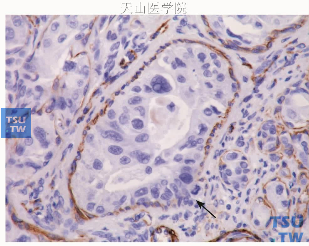 多形性腺瘤癌变：部分肿瘤细胞突破肌上皮细胞包绕（箭头）