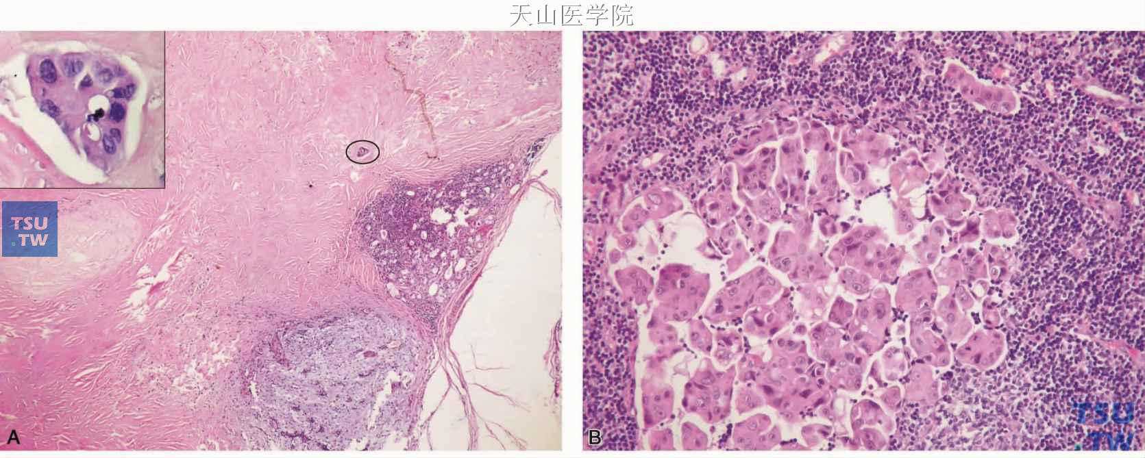 多形性腺瘤原位癌变并发生转移 A.肿瘤的大部分发生玻璃样变，但包膜完整，左上角的插图为椭圆形框内肿瘤细胞的高倍观；B.淋巴结转移成分与原发灶的成分一致