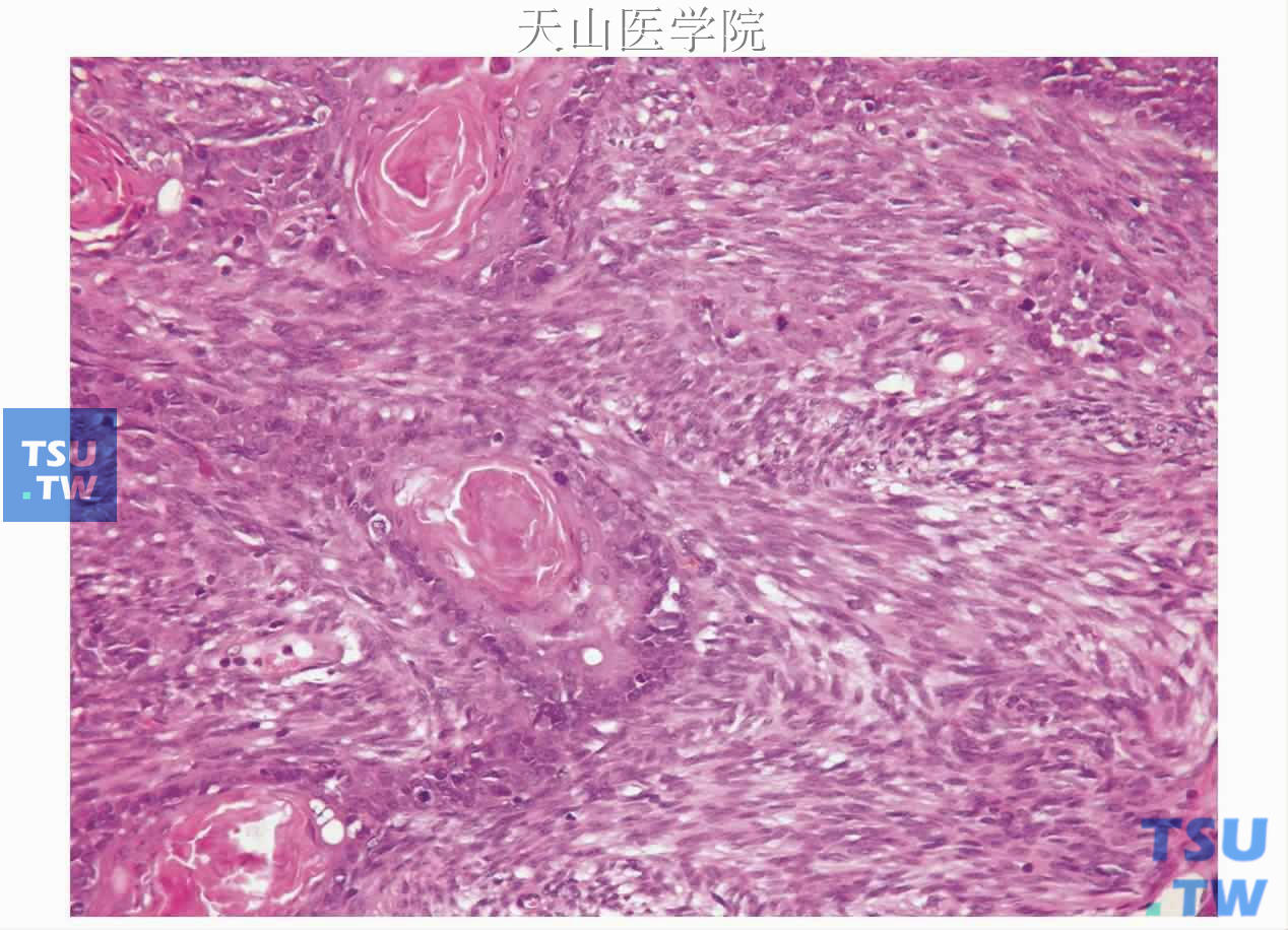 腮腺癌肉瘤：鳞状细胞癌与纤维肉瘤