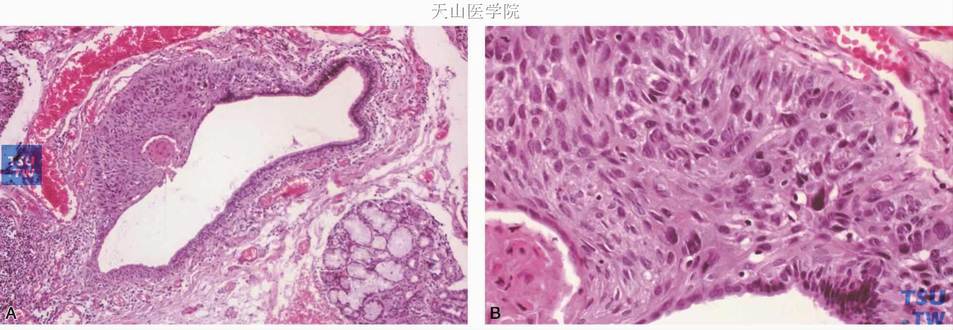 鳞状细胞癌 A.唾液腺导管内衬上皮增生，呈原位癌表现；B.高倍镜下见肿瘤的异型性和角化珠