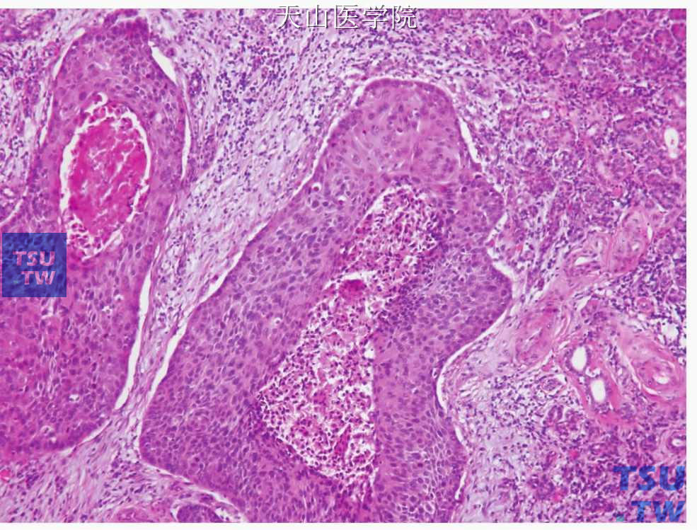 鳞状细胞癌：肿瘤细胞团中央的坏死
